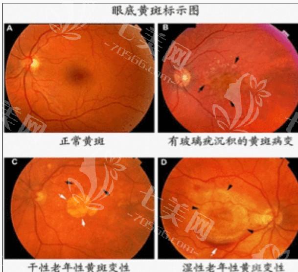 郑州激光老视有名的眼科医院排名 公布排名靠前的正规眼科医院