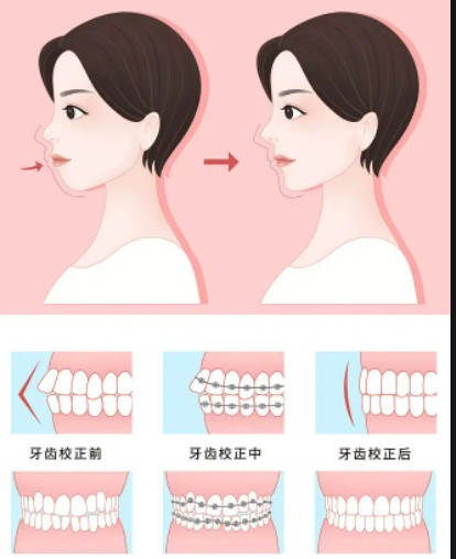 做眼底脂肪重置后，如何快速恢复自然美丽的眼睛？