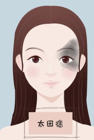 做鹰钩鼻矫正过程快速恢复自然美观?