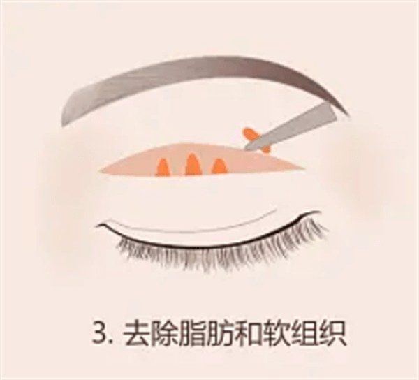做下颌角整形前 10 大注意事项你了解吗？