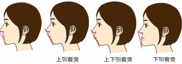 做角膜塑形镜前你需要知道的事项