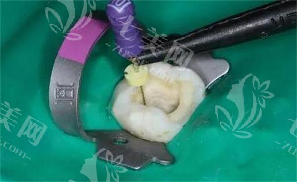 广州根管治疗多少钱一颗牙