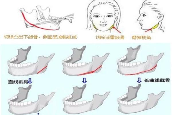 广州三大出名磨骨医生名单公布:何锦泉/聂云飞/徐威强实力强上榜附价格