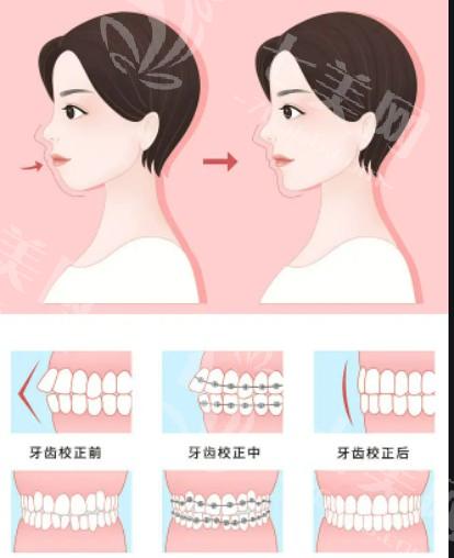 自体脂肪隆鼻真实过程大揭秘 塑造完美鼻型无遗憾