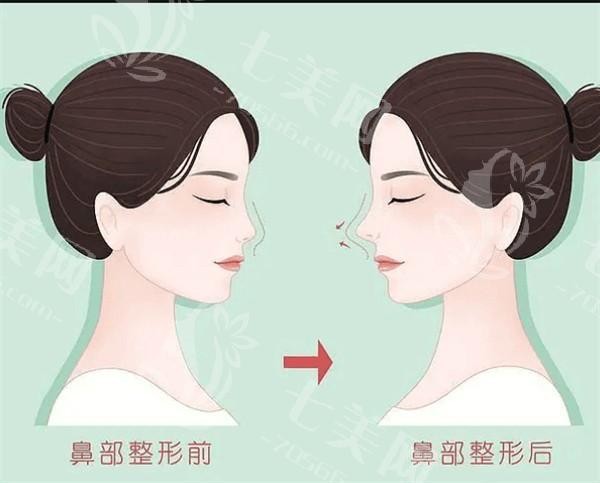 东莞膨体隆鼻排名好的医院名单 上榜的口碑也不错