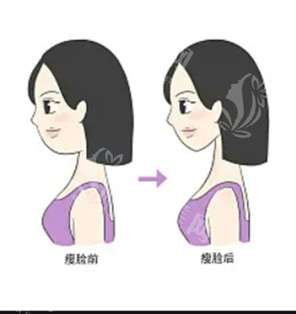 做热玛吉的过程是什么？揭秘你不知道的细节与效果！