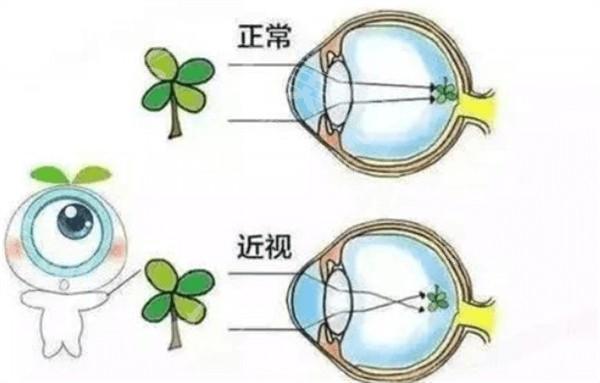 重庆单焦点晶体比较好的眼科医院 都是眼科技术口碑好的医院